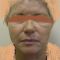 Facelift, SMAS Facelift