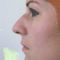 Plastika nosu (Rhinoplastika)
