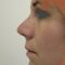 Plastika nosu (Rhinoplastika)
