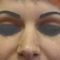 Plastika nosu (Rhinoplastika)