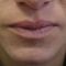 Lippenvergrößerung