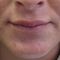 Lippenvergrößerung