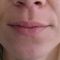 Lip augmentation - cheiloplasty