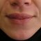 Lip augmentation - cheiloplasty