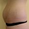 Abdominoplastika (Operace břicha)