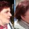 Lifting du visage
