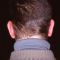 Ear surgery (Otoplasty)