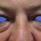 Eyelid surgery (Blepharoplasty)