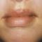 Lippenvergrößerung