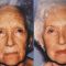 Fractional Laser Resurfacing