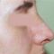 Nasenkorrektur - Rhinoplastik