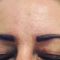 Kwas hialuronowy: Saypha, Restylane, Juvederm, Stylage