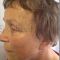 Facelift, SMAS Facelift