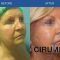 Lifting facial