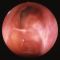 Treatment of Chronic Rhinitis