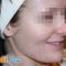 Laser Scar Treatment