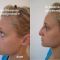 Rhinoplastie médicale