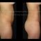 Lipoescultura láser - Cool Lipo