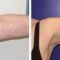 Lifting delle braccia