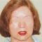 Facelift, SMAS Facelift