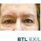 Lifting non chirurgico (Exilis)