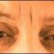 Dermal fillers