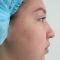 Cirugía de la nariz (Rinoplastia)