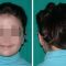Operazione orecchie (Otoplastica)