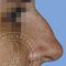 Plastika nosu (Rhinoplastika)