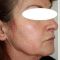 Facelift (operace obličeje), SMAS lifting