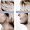 Liposuction