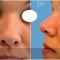 Operácia nosa (Rhinoplastika)