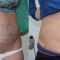 Liposukcja laserowa