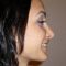 Rhinoplastie