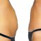 Abdominoplastika (Operácia brucha)
