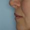 Ingrandimento labbra con grasso (lipofilling)