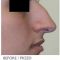Rhinoplasty (Nose Job)