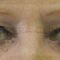 Operácia očných viečok (Blepharoplastika)