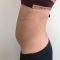 Liposukcja laserowa