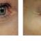 Fotorejuvenizácia /Resurfacing