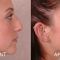 Rhinoplastie