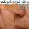 Kwas hialuronowy: Saypha, Restylane, Juvederm, Stylage