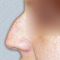 Plastika nosu (Rhinoplastika)