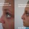 Rhinoplastie médicale