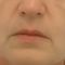 Facelift