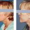 Facelift