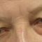 Eyelid surgery (Blepharoplasty)
