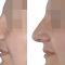 Rhinoplasty (Nose Job)