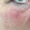 Laserové zákroky estetické dermatologie