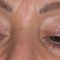 Blépharoplastie